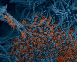 cellules bronchiques humaines (bleues) infectées par le virus SARS-CoV-2 
