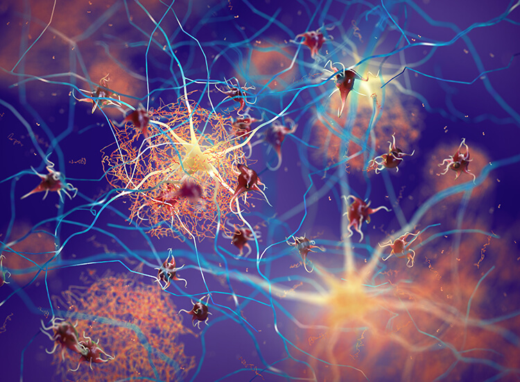 Plaques amyloïdes se formant entre les neurones en illustration 3d. Les cellules nerveuses perturbant les protéines bêta-amyloïdes fonctionnent dans un cerveau atteint de la maladie d'Alzheimer