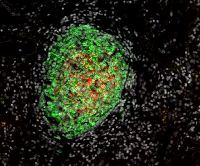 Germinal center with CD20+ B cells (green) and CD21+ follicular dendritic cells (orange) of a tertiary lymphoid structure associated with human lung tumor