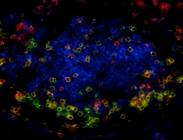 T cell (green and orange) and B cell (blue) segregation within tertiary lymphoid structures in human lung tumor