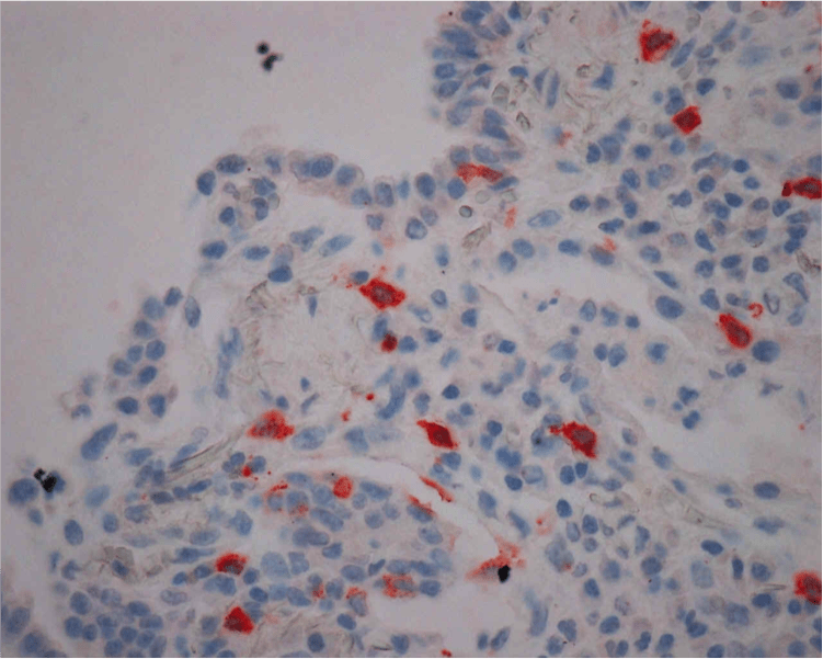 Expression of NKp46+ NK cells in lung of patient with antisynthetase syndrom